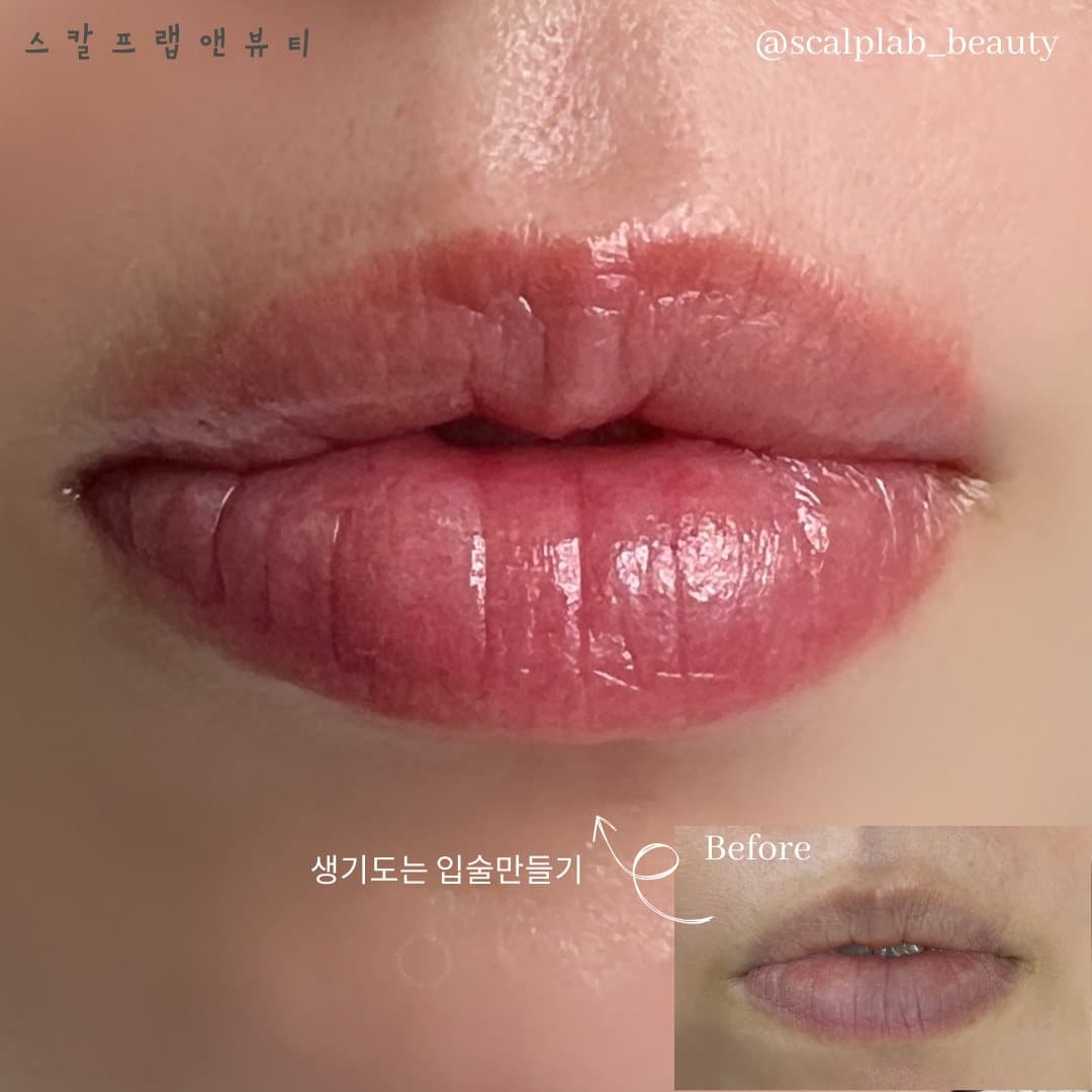 틴트 입술 시술 사진