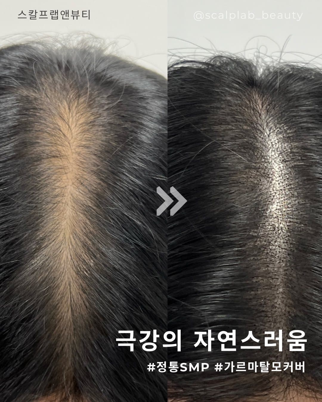 두피·헤어라인 시술 사진