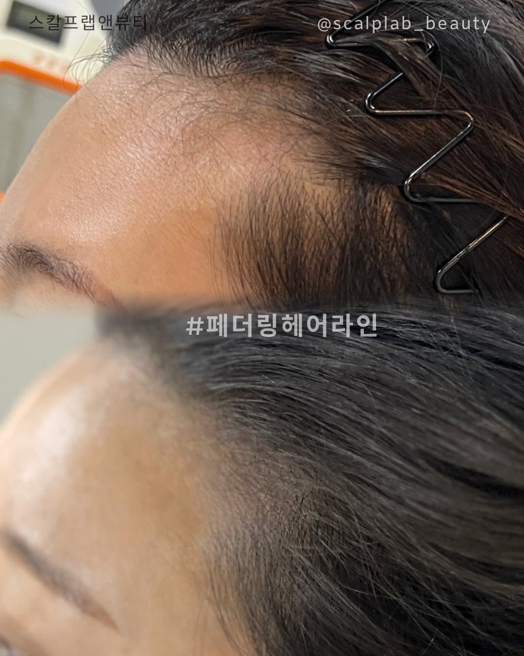 두피·헤어라인 · 페더링 헤어라인