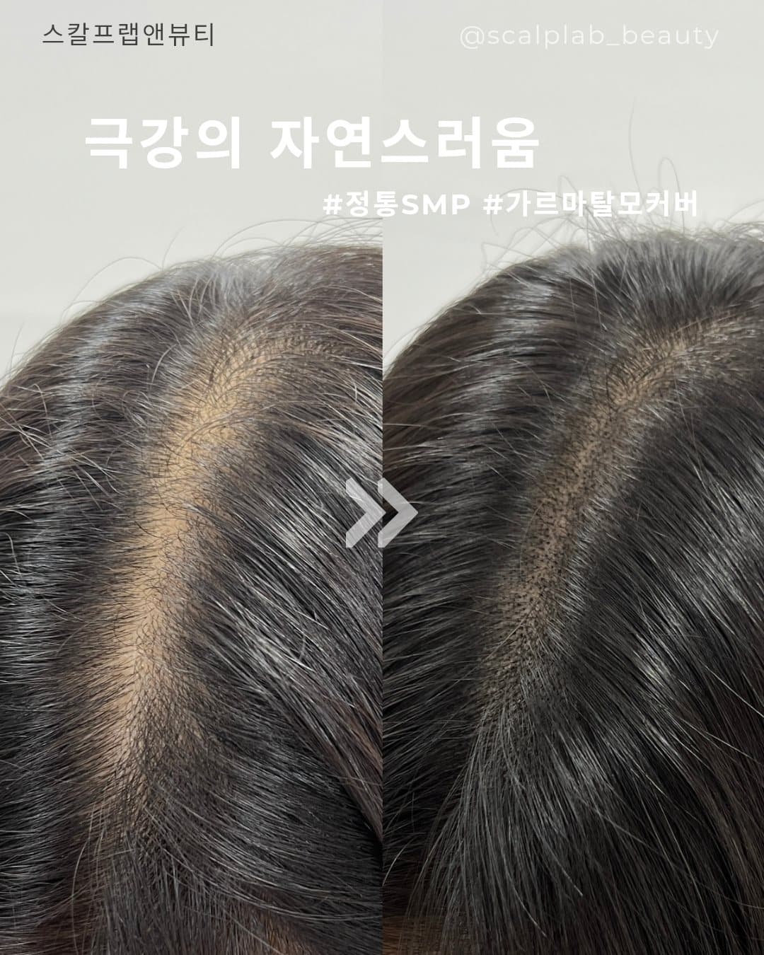 두피·헤어라인 · 가르마 탈모커버 전·후
